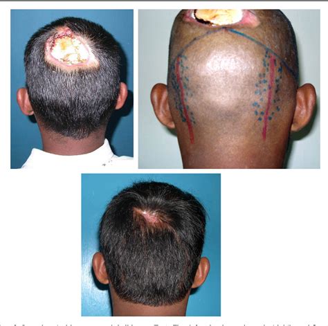 Figure From Occipital Artery Island V Y Advancement Flap For