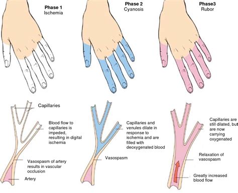 Figure 1 From Sildenafil In The Treatment Of Raynauds Phenomenon Resistant To Vasodilatory