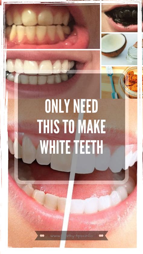 Pearly White Teeth Are A Sign Of Good Dental Hygiene And They Look