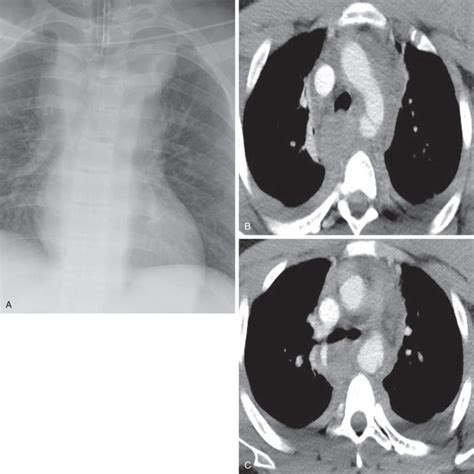 Blunt Thoracic Trauma Radiology Key