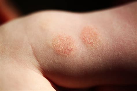 Eczema In Kids What Parents Can Do To Calm The Itch For Parents Us