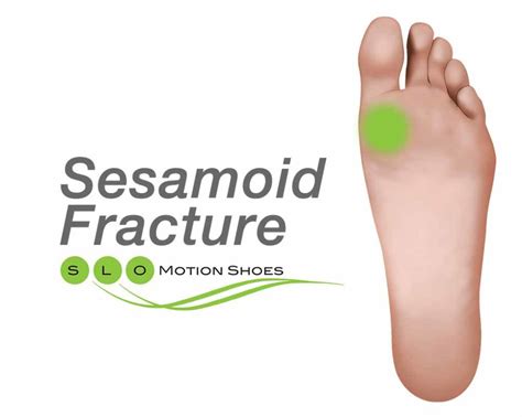 Sesamoid Fracture Slo Motion Shoesslo Motion Shoes