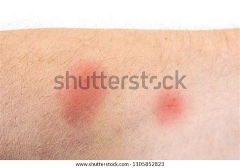 Bites Insect On Male Body Bed Stock Photo 1105852823 Shutterstock