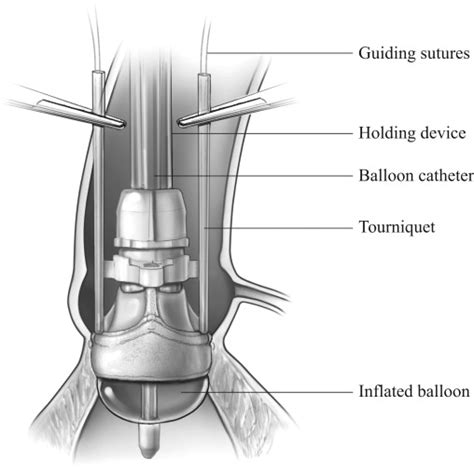 Sutureless Aortic Valve Implantation Operative Techniques In Thoracic And Cardiovascular Surgery