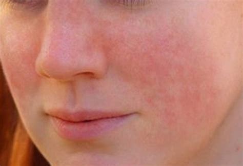 Аллергия На Теле Фото С Пояснениями — Картинки фотографии