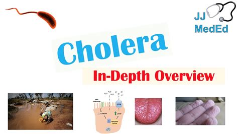 Cholera Vibrio Cholerae Pathophysiology Risk Factors Symptoms