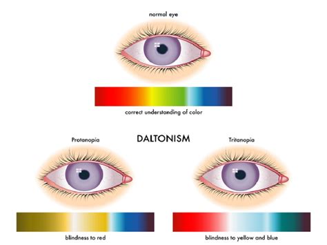 Colour Blindness Symptoms Causes And Treatments