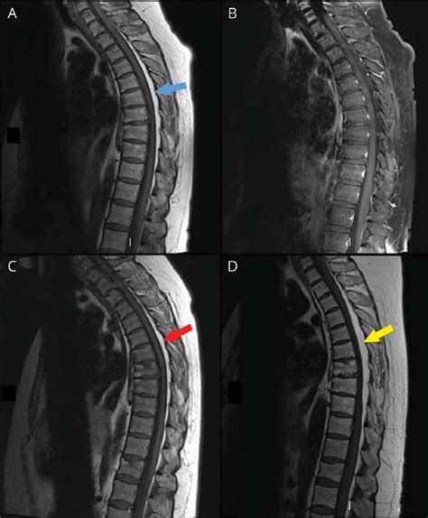 Sagittal T Weighted Mri Shows Epidural Lipomatosis With Compression Of