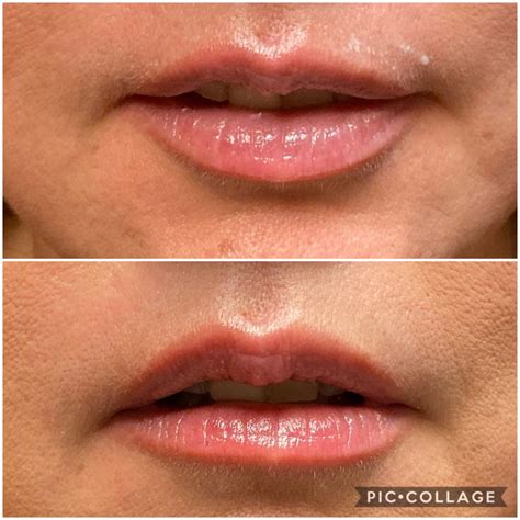 The Botox Lip Flip Botox Lips Botox Botox Wrinkles