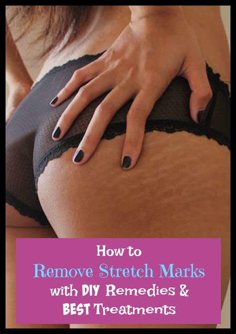 How to uninstall chromium with revo uninstaller. How to Remove Stretch Marks Naturally With Home Remedies ...
