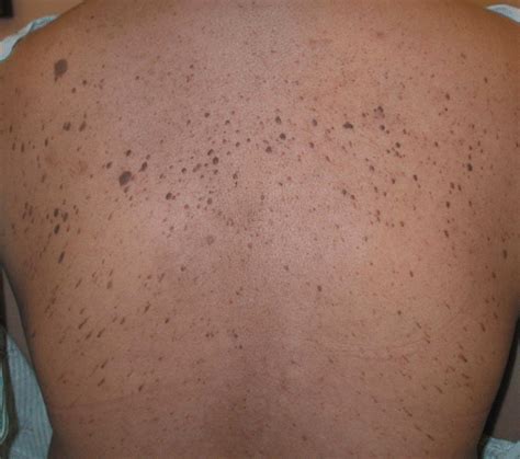 Eruptive Dermatosis Papulosa Nigra As A Possible Sign Of Internal