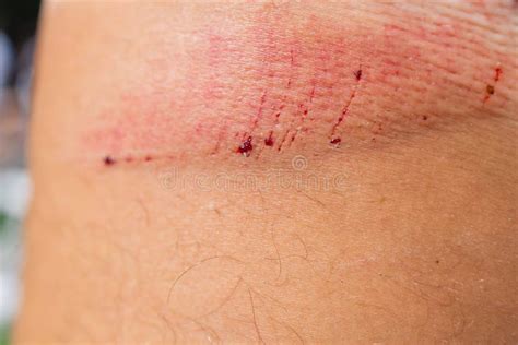 Scratch Lesion Caused By The Accident On Leg Skin Stock Photo Image