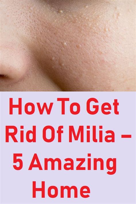 How To Get Rid Of Milia 5 Amazing Home Remedies Bumpy Skin Home