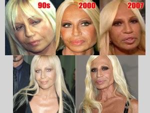 Top 10 Most Drastic Plastic Surgeries Gone Wrong For Our Most Favorite