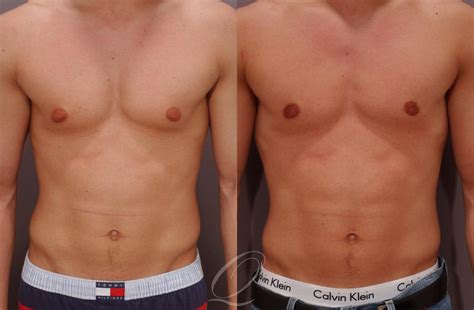 Male Breast Reduction Before After Photos Patient 190 Serving