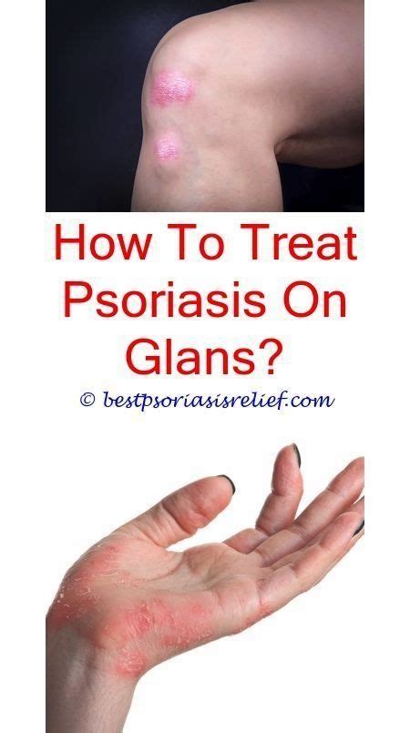 Plaquepsoriasiscauses What Causes Psoriasis To Flare Up Pustular