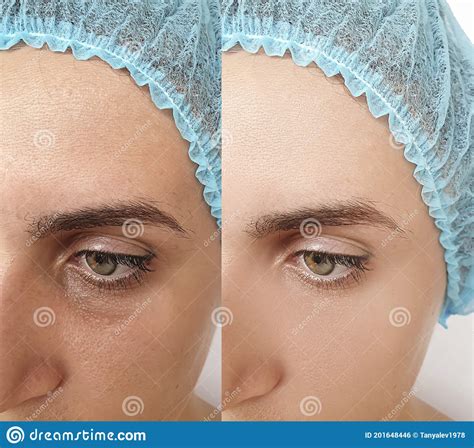 Woman Double Chin Before And After Treatment Stock Photo Image Of