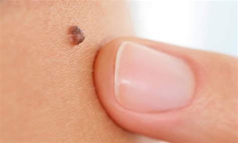 Right Arm Has More Than 11 Moles Increase Skin Cancer Risk Siowfa15