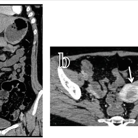 Radiological Findings Seen In Active Crohns Disease On Mdcte