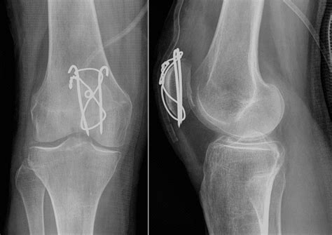 Patella Fracture Teachmesurgery