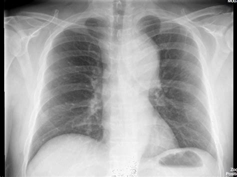 Aortic Dissection On Chest X Ray