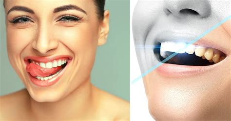 How To Whiten Bonded Teeth At Home All You Need To Know