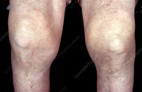 Severe Gout Knees Stock Image C0504420 Science Photo Library