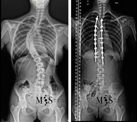 Cirugía De La Escoliosis Morgenstern Institute Of Spine