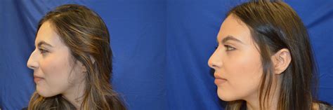 Nose Surgery Before And After Photos Patient 145 San Francisco Ca