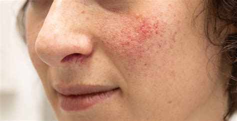 This formula has been created for and tested by my customers. What is Rosacea? - SLMA