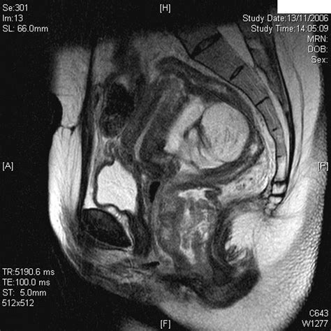 Undiagnosed Rectal Tumour A Rare Cause Of Obstructed Labour In The