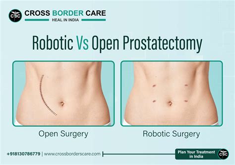 Conventional Prostatectomy Vs Robotic Prostatectomy A Detailed Comparison