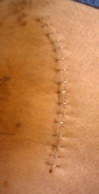 Post 7 Day Surgical Incision My XXX Hot Girl
