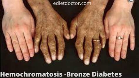 Bronze Diabetes Treatment And Prevention