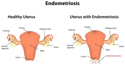 Endometriosis In Nigeria Causes Symptoms Treatment Fabwoman