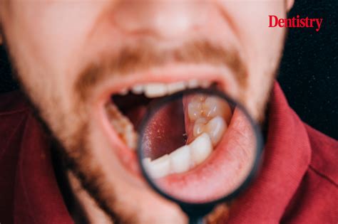 Oral Cancer The Importance Of Early Diagnosis Dentistry