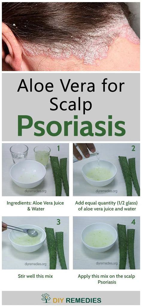 Aloe Vera For Scalp Psoriasis Scalp Psoriasis Can Be Appeared As Raised