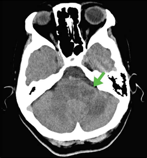 Central Nervous System Lymphoma Mimicking Bell Palsy Cleveland Clinic