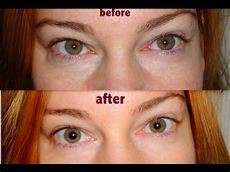 Most people don't have firsthand knowledge about lasik or an talk to an eye surgeon in whom you feel confident and get your questions answered. how to get rid of bags under eyes - how to get rid of bags ...
