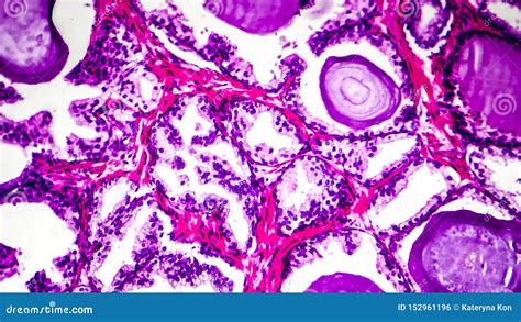 Histopatología De La Hiperplasia De La Glándula De Próstata Foto de archivo Imagen de