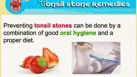 Top 4 Tips To Prevent Tonsil Stones Tonsilloliths Natural Tonsil
