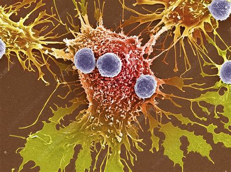 But perhaps the problem is more with the word cancer than the word good. T lymphocytes and cancer cells, SEM - Stock Image - M132 ...