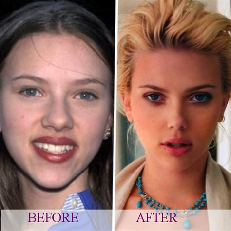 Celebrity Scarlett Johansson S Plastic Surgery Photos