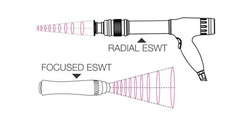 Difference From Radial And Focused Shockwave Machine
