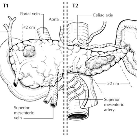 Regional Lymph Nodes Of The Pancreas Anterior View From Greene Et