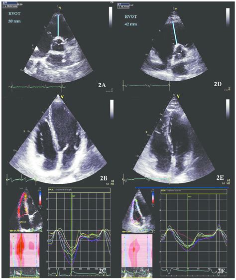 Echocardiographic Assessment Of An Athlete With Right Ventricle