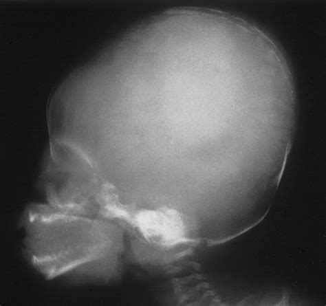 The Infant Skull A Vault Of Information Radiographics