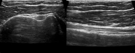 Long Head Of The Biceps Tendon Lhbt Published In International