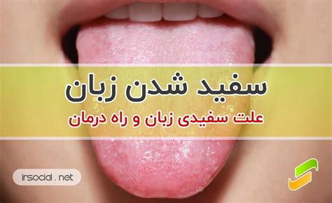 عجیب ترین علت سفید شدن زبان و دیدن لکه های سفید روی زبان روش درمان