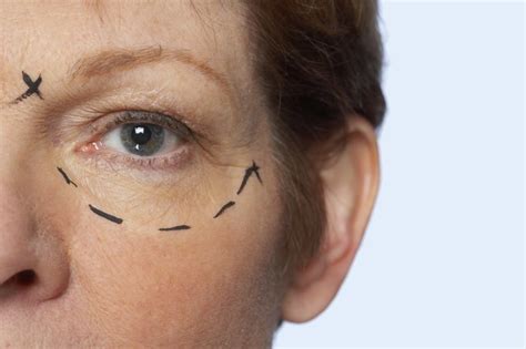 Conheça A Blefaroplastia A Laser